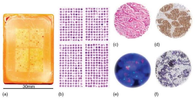 Tissue microarrays and TMA applications. (a) TMA block; (b) hematoxylin and Eosin (H&E)-stained section (5 |m) of the TMA; (c) magnification of a H&E-stained tissue spot (diameter 0.6 mm); (d) immunohistochem-istry of a breast cancer tissue spot. Brownish membranous staining indicates strong expression of the Her2 receptor protein. (e) FISH analysis. Magnification (1000x) of cell nuclei (blue staining) showing two green signals corresponding to the centromere of chromosome 17 and multiple=