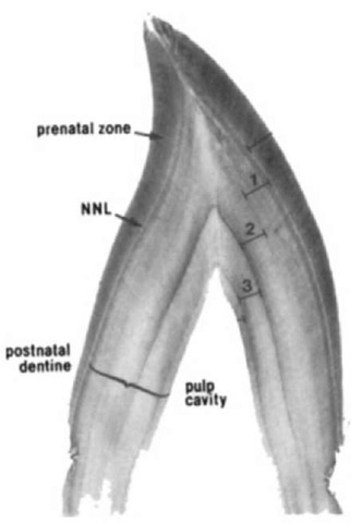 Decalcified and stained midlongitudinal section in the buccal-lmgual plane from a free-ranging bottlenose dolphin known to be 3 years of age. This view shotvs only the upper half of the section. The neonatal line (NNL) represents the time when the animal was born and, therefore, is age "0" for the purpose of estimating age. Dentine external to the neonatal line was deposited before birth and is known as prenatal dentine, whereas the neonatal line and dentine internal to it is postnatal dentine. A thin layer of enamel covered the prenatal dentine but was removed when the tooth was decalcified. The first three complete presumed annual growth layers or GLGs are marked in the sequence they were deposited. Teeth from young dolphins have very little cement and none can be seen in this photograph. 