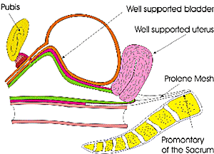 transvaginal mesh procedure transvaginal surgical mesh
