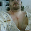 2 days post-op. Finally recovered enough to grab my phone and take a pic. This was the first time I could look at my scar, too.
