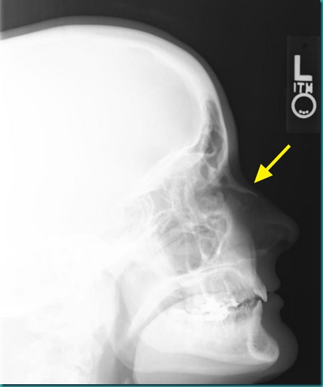 Broken Nose X-Ray 1