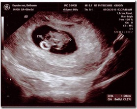 Sonogram 1(8weeks)