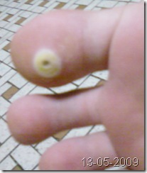 2009-05-13 - toeCorn