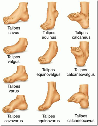 pes planus asymptomatic