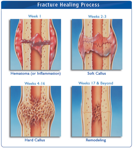 Plastic+bowing+fracture