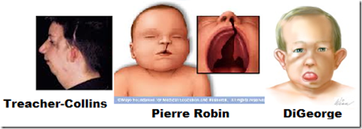 pierre robin sequence vs treacher collins pierre robin sequence vs treacher collins