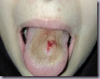 infected_tongue_piercing