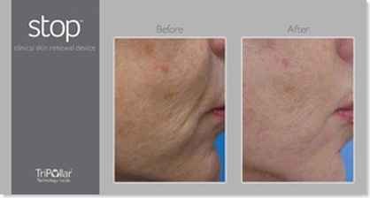 before_after_cheek stopage