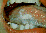 [kanker mulut[4].gif]