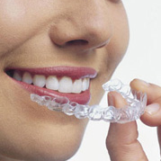 [kawat gigi invisalign[1].png]