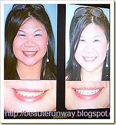 holloywood smile orchard scotts dental beaute runway before n after