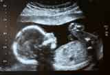 Social Services Removes Foster Children from Foster Parent Who Opposed Allegedly Coerced Abortion
