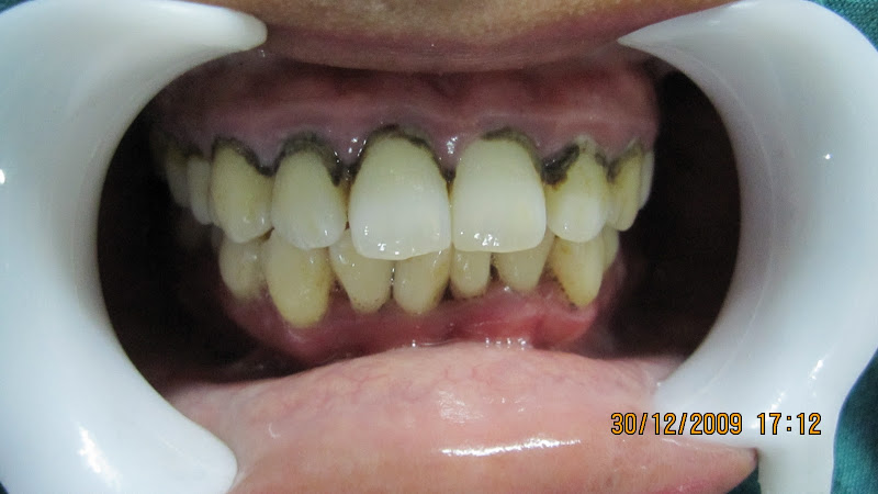 dental calculus