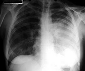 plaque lung