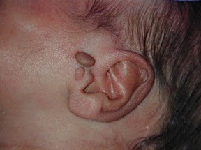 preauricular skin tag
