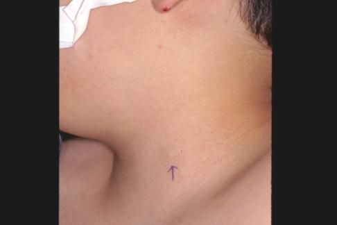 branchial cleft cyst