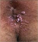 anal wart