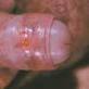 LGV ulcer