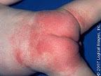 ผื่นแพมเพิร์ส ที่ไม่ได้เกิดจากการติดเชื้อ ( Non infective diaper dermatitis )