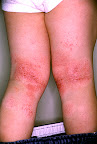 ภูมิแพ้ผิวหนัง (Atopic dermatitis)