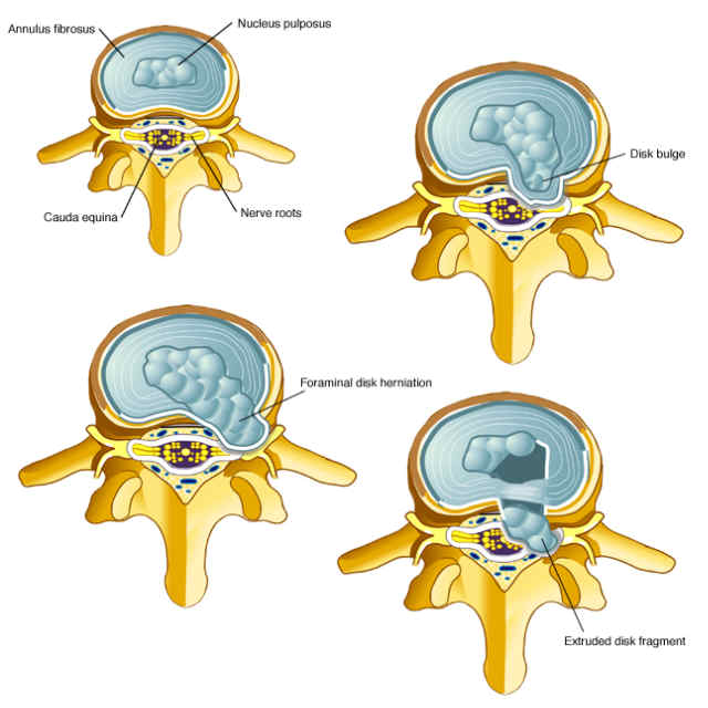 disc herniation