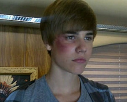 biebergolpeado