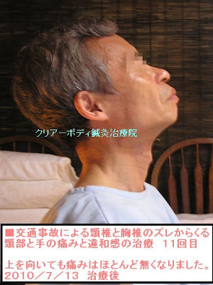 首の痛みとてのしびれ