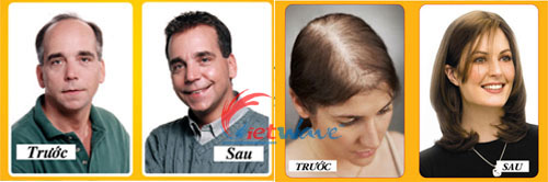 rụng tóc, hói đầu, bị rụng tóc nhiều, đầu tự nhiên bị hói, ngăn rụng tóc, chống rụng tóc, thuốc mọc tóc, thuốc kích thích mọc tóc, làm sao ngăn tóc rụng, dầu gội ngăn rụng tóc, dầu gội chống rụng tóc, dầu gội kích thích mọc tóc, thuốc mọc tóc nhanh, dung dịch kích thích mọc tóc, thuốc mọc lông, dưỡng tóc, chăm sóc tóc, Trị Rụng Tóc, kích thích tóc mọc nhanh, X-Hair, Thuốc mọc tóc cao cấp, Giúp mọc tóc một cách tự nhiên và hiệu quả rụng tóc, hói đầu, bị rụng tóc nhiều, đầu tự nhiên bị hói, ngăn rụng tóc, chống rụng tóc, thuốc mọc tóc, thuốc kích thích mọc tóc, làm sao ngăn tóc rụng, dầu gội ngăn rụng tóc, dầu gội chống rụng tóc, dầu gội kích thích mọc tóc, thuốc mọc tóc nhanh, dung dịch kích thích mọc tóc, thuốc mọc lông, dưỡng tóc, chăm sóc tóc, Trị Rụng Tóc, kích thích tóc mọc nhanh, X-Hair, Thuốc mọc tóc cao cấp, Giúp mọc tóc một cách tự nhiên và hiệu quả