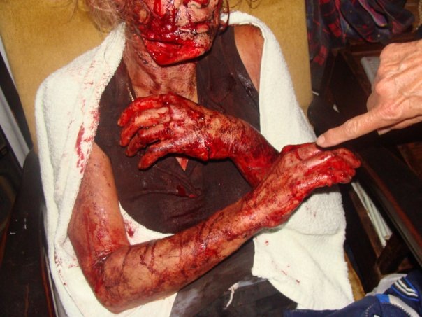 [Viljoenskroon farm attack victim panga injuries Jan 25 2010 pic Carien Somers Dippenaar Facebook.jpg]