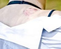 [Kirsty, Ivy, pupil Pretoria Overkruin HS bitten on shoulder by robberl[5].jpg]
