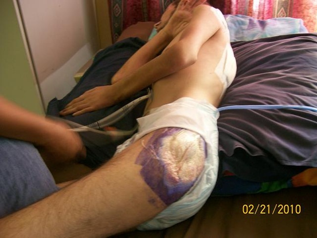 [Steenbergen Jaco Pelomoni hospital neglect caused dreadful bedsores infections[5].jpg]
