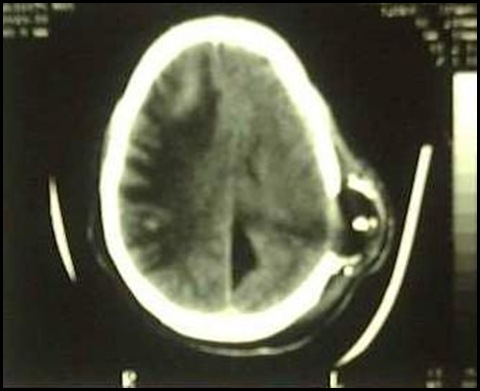 Gunshot head injury brain damage Trauma Society of SA
