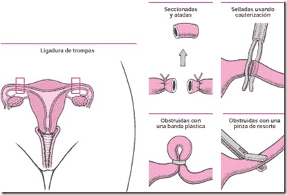 ligadura