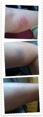 [ouchies[5].jpg]