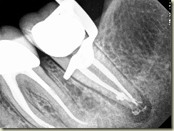 Endodontic Complexity check filmb
