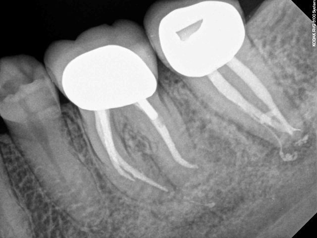 [Endodontic Complexity postop2b.jpg]