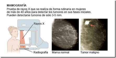 mamografia2