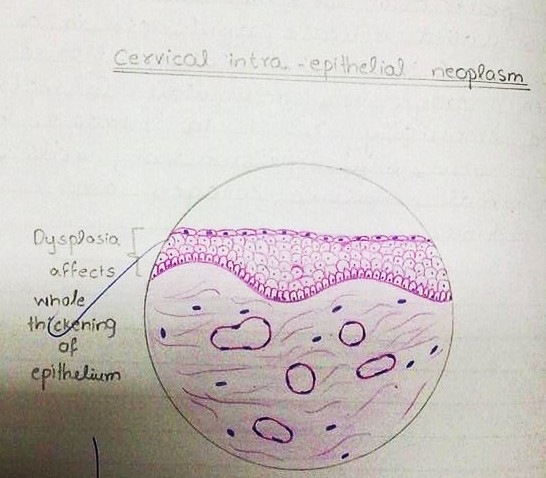 [cervical intraepithelial neoplasm diagram H&E[2].jpg]