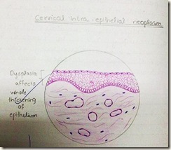 cervical intraepithelial neoplasm diagram H&E