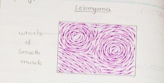 [leiomyoma diagram H&E[2].jpg]