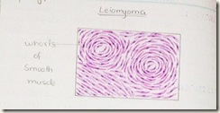 leiomyoma diagram H&E