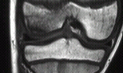 Daily Dose: Microfracture