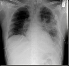 XR_chest_-_pneumonia_with_abscess_and_caverns_-_d0