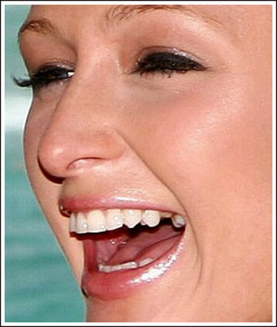 paris hilton tooth