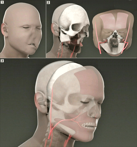 [facial_transplant[3].gif]