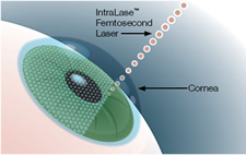 iLASIK: An Alternative Vision Correction Procedure