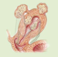 [uterine_fibroids[3].jpg]