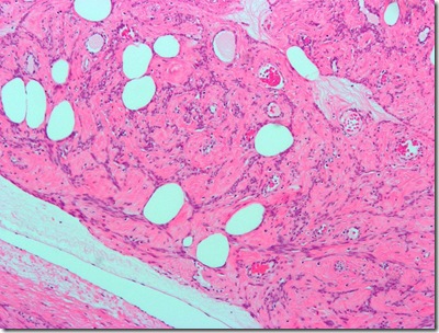 800px-Lipoleiomyoma2 800px-Lipoleiomyoma2