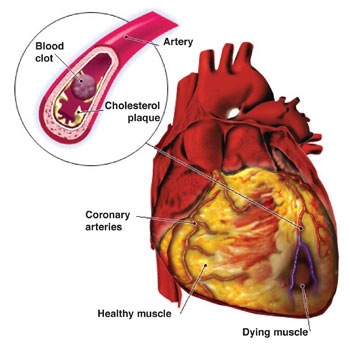 [Cardiovascular.Disease[6].jpg]