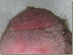 Vacuum_Extraction_bruised_scalp Vacuum_Extraction_bruised_scalp
